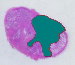 Image:Tumor_marked(v31)1x_1868_10_0.jpg